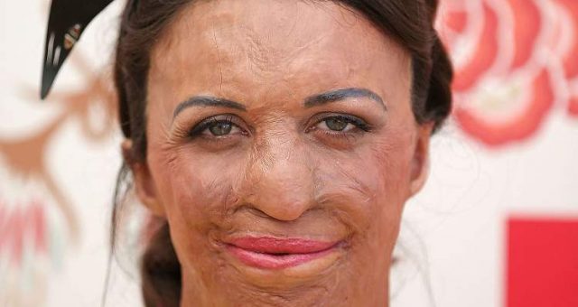 What Happened To Turia Pitt How Did She Get Burned